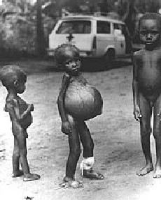 kwaskiokor victims of Yakubu Gowon's war
